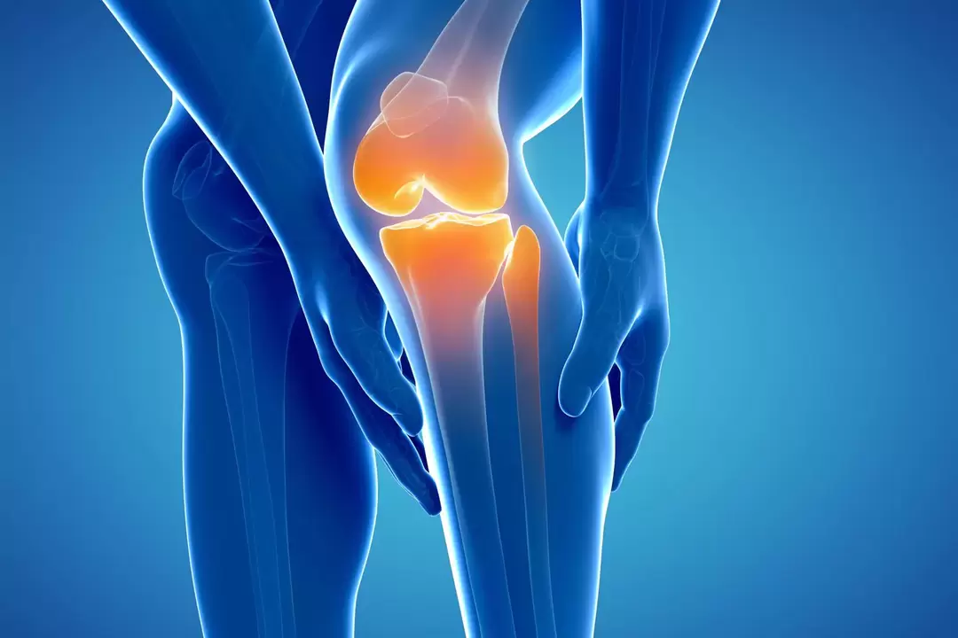 Артроз колінного суглоба (гонартроз, деформуючий остеоартроз)